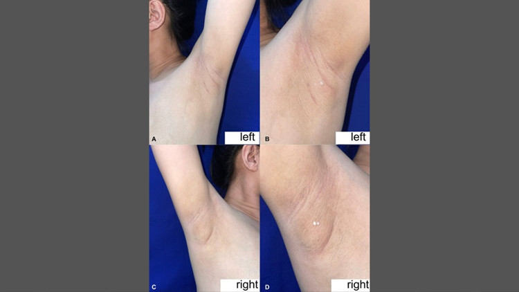 Filipinli kadının koltukaltından süt geldi: Nadir görülen durumun nedeni ne?